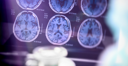 Descoberta científica na NOVA Medical School abre caminho para novas abordagens na doença de Alzheimer