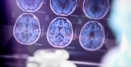 Universidade de Coimbra desenvolve radiofármaco inovador para diagnóstico mais preciso da doença de Alzheimer