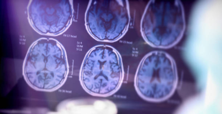 EUA autorizam novo tratamento para doença de Alzheimer