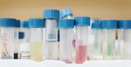 Investigadores criam biossensores descartáveis para deteção precoce do Alzheimer