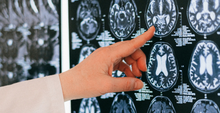 Alzheimer: EUA aprovam primeiro tratamento em mais de 20 anos