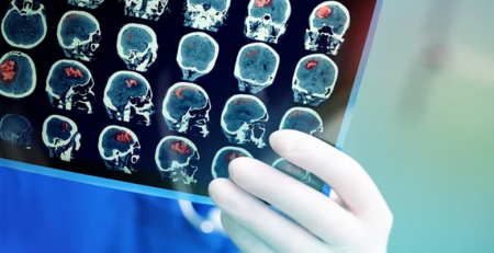 Encontrada associação entre altura e densidade de neurónios dopaminérgicos na substância negra
