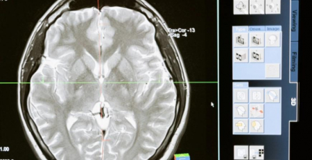 Coimbra lidera consórcio europeu com foco na prevenção de doenças cerebrovasculares